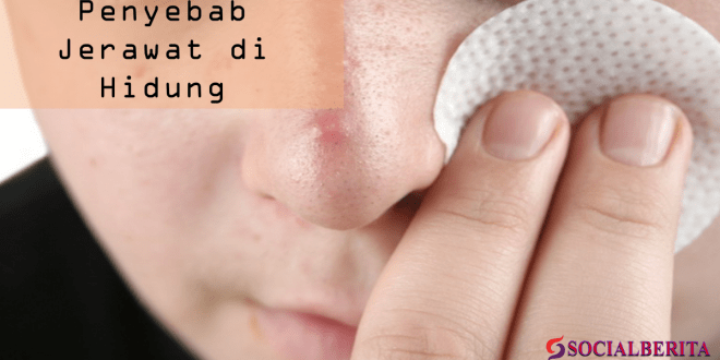 Penyebab Jerawat di Hidung dan Cara Menghilangkannya